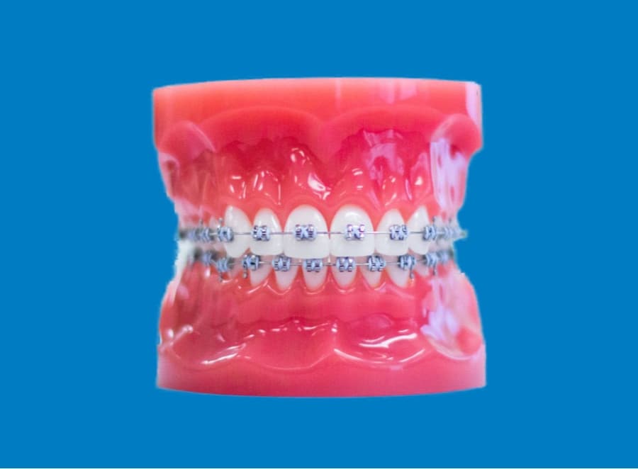 metal braces on plastic model