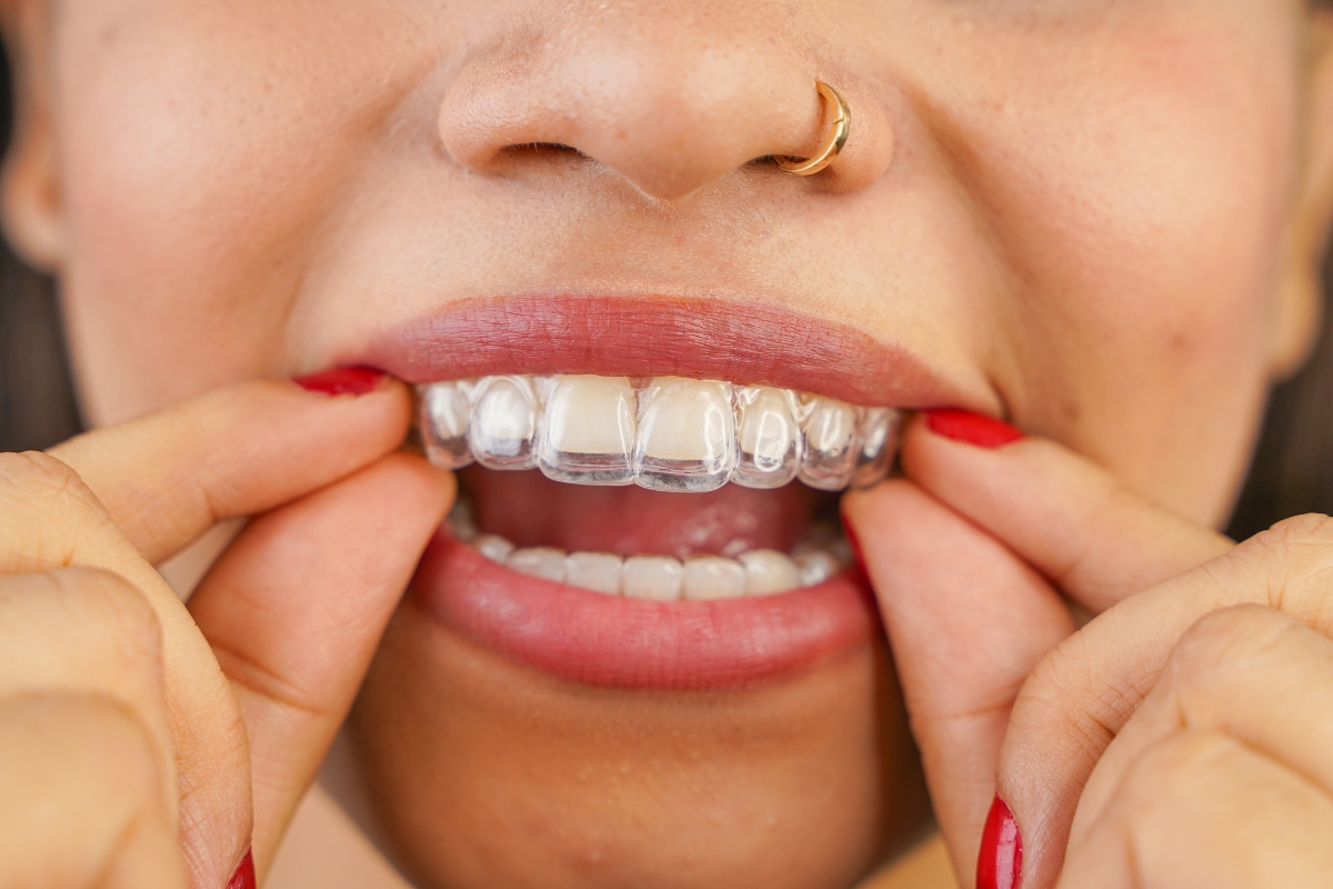 Invisalign in Houston