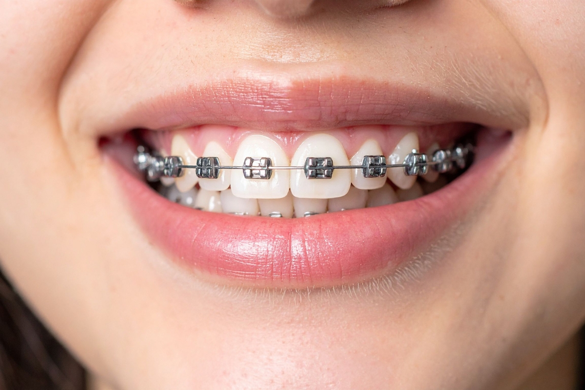 metal braces in Houston