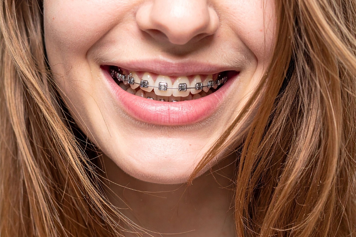 metal braces in Tomball